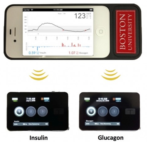 Cientistas criam “pâncreas biônico” controlado por smartphone para tratar de diabetes