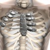 Um senhor de 54 anos recebeu a primeira prótese de costelas feita em impressora 3D