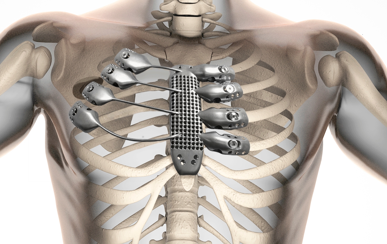 Um senhor de 54 anos recebeu a primeira prótese de costelas feita em impressora 3D