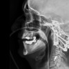 Vértebras feitas em impressora 3D salvam homem com tumor na coluna