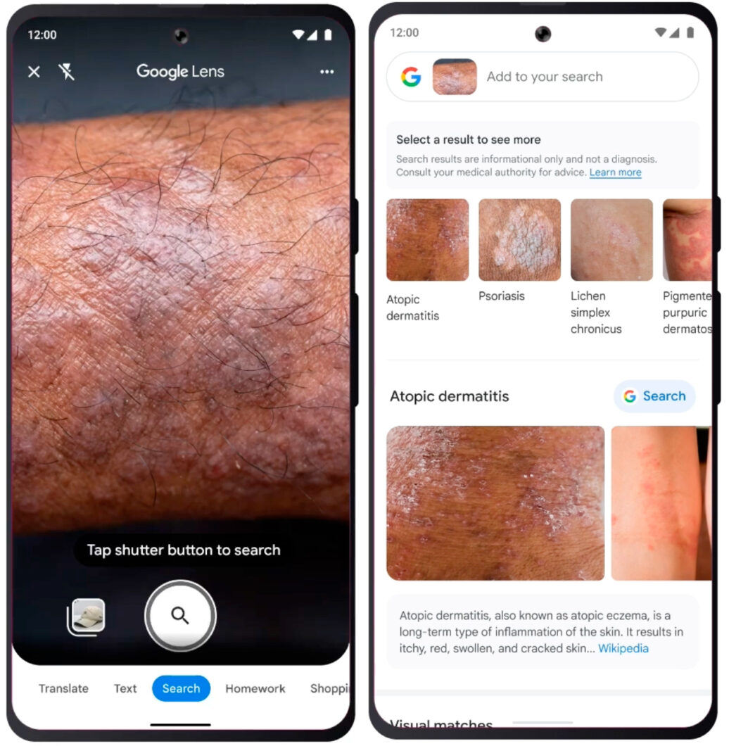 Busca por foto de pele no Google Lens retorna resultado com doenças dermatológicas (Imagem: Divulgação/Google)